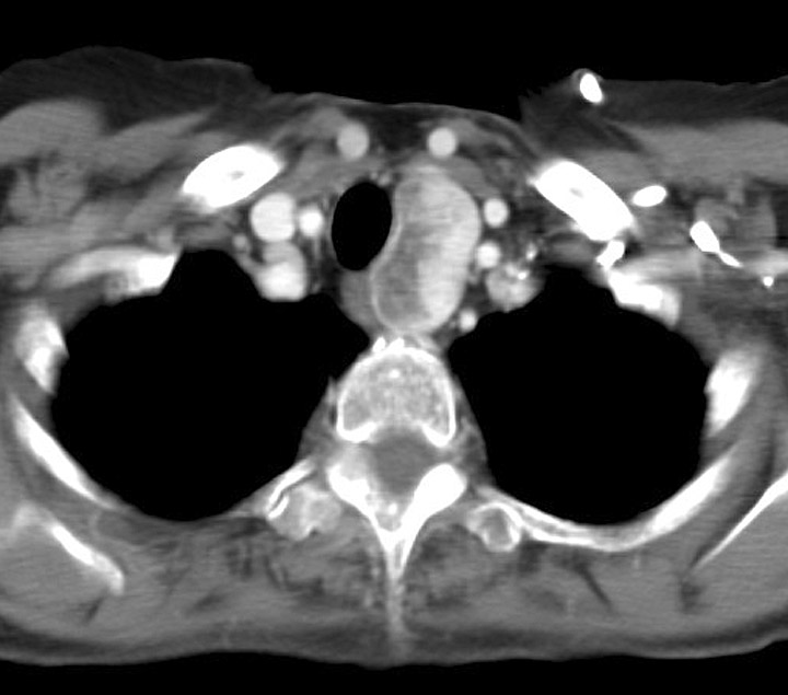 Thyroid Mass
Case 1 CT