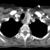 Thyroid Mass
Case 1 CT