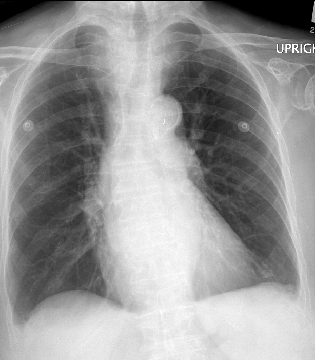 Thyroid Mass
Case 2 PA