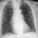 Thyroid Mass
Case 2 PA