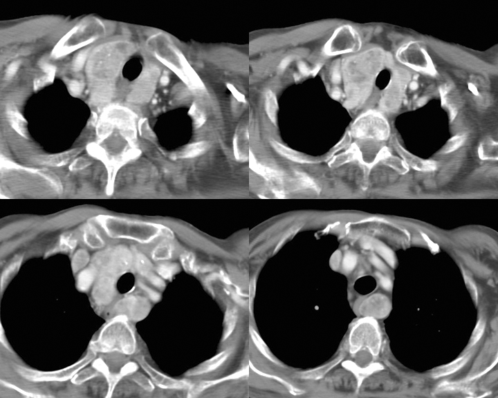 Thyroid Mass
Case 2 CT