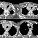 Масштабная масса щитовидной железы 2 CT