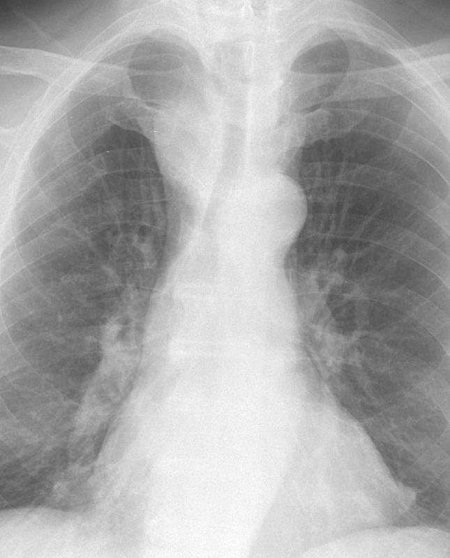 Thyroid Mass
Case 3 PA