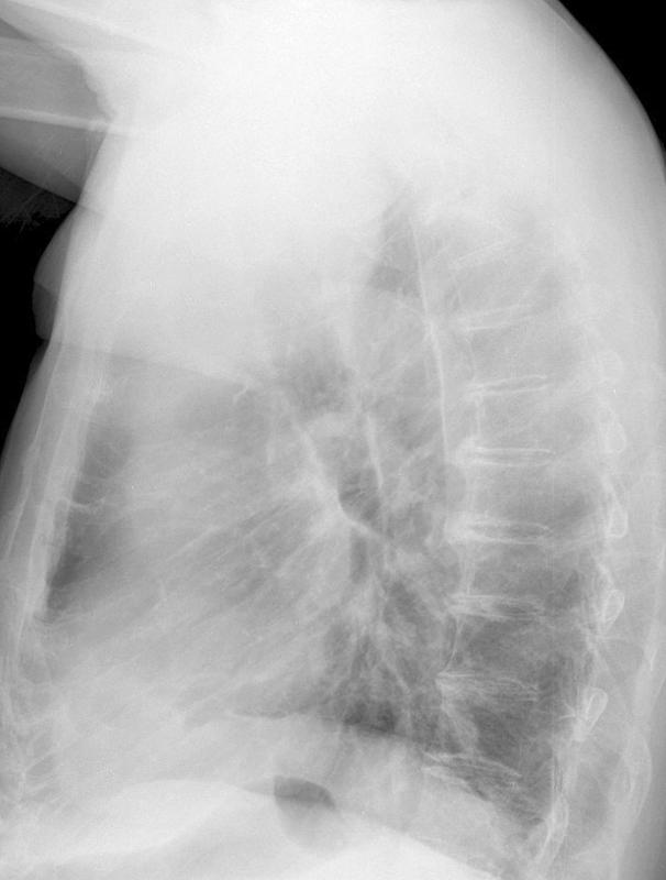 Thyroid Mass
Case 3 Lat