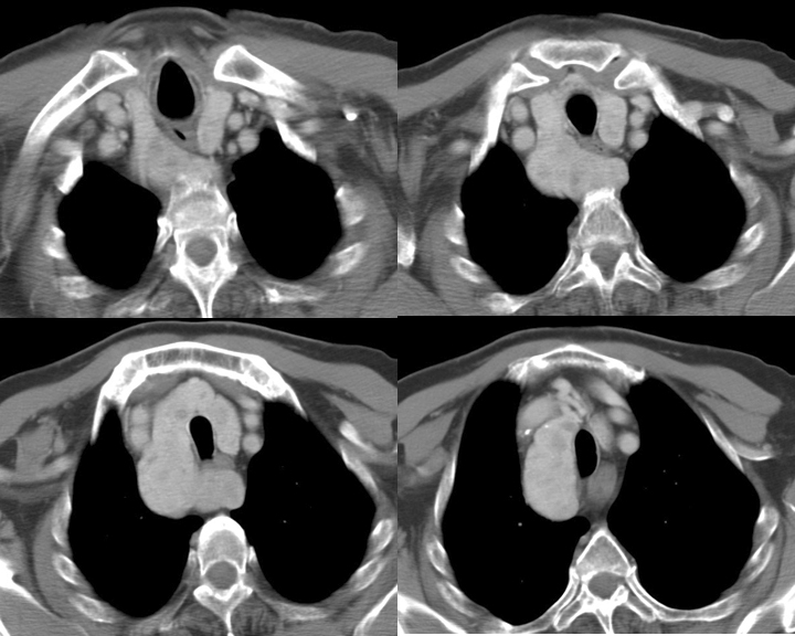 Thyroid Mass
Case 3 CT