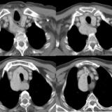 Thyroid Mass
Case 3 CT