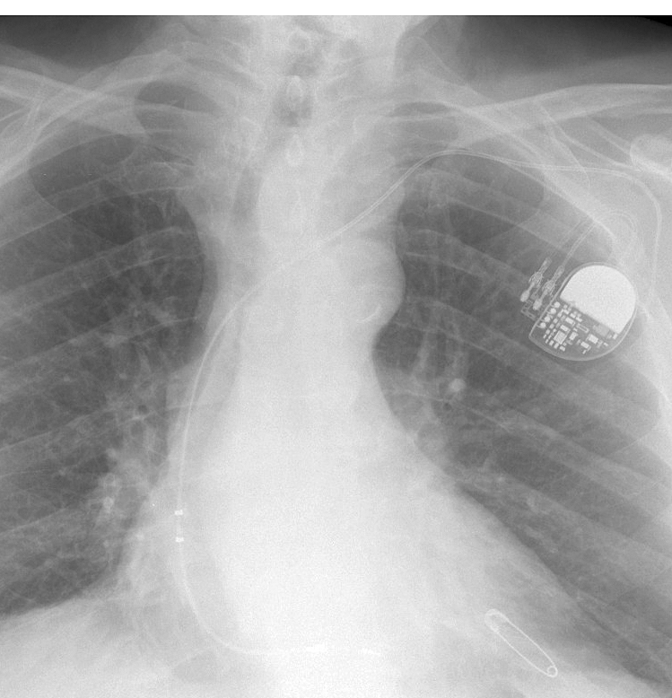 Thyroid Mass
Case 4 PA