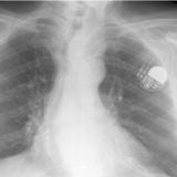 Thyroid Mass
Case 4 PA