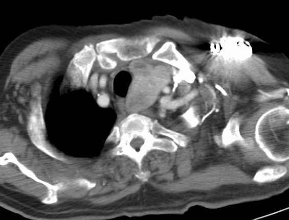 Thyroid Mass
Case 4 CT