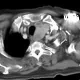 Thyroid Mass
Case 4 CT