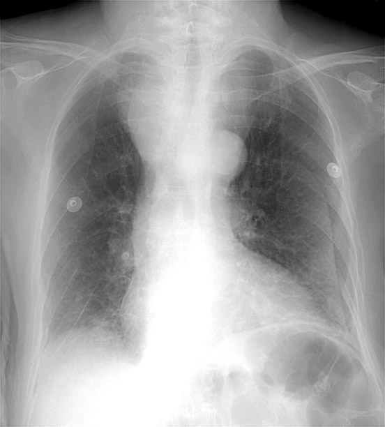 Thyroid Mass