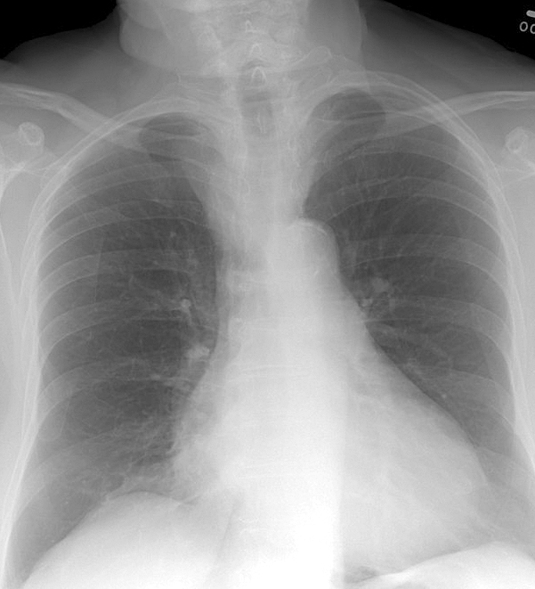 Thyroid Mass
Case 6 PA