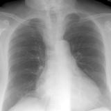 Thyroid Mass
Case 6 PA