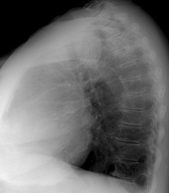 Thyroid Mass
Case 6 Lat