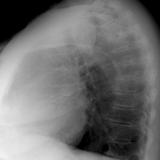 Thyroid Mass
Case 6 Lat