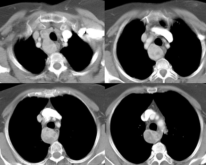 Thyroid Mass
Case 6 CT