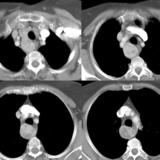 Thyroid Mass
Case 6 CT