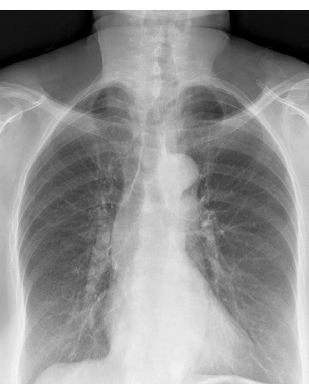 Thyroid Mass
Case 7 PA