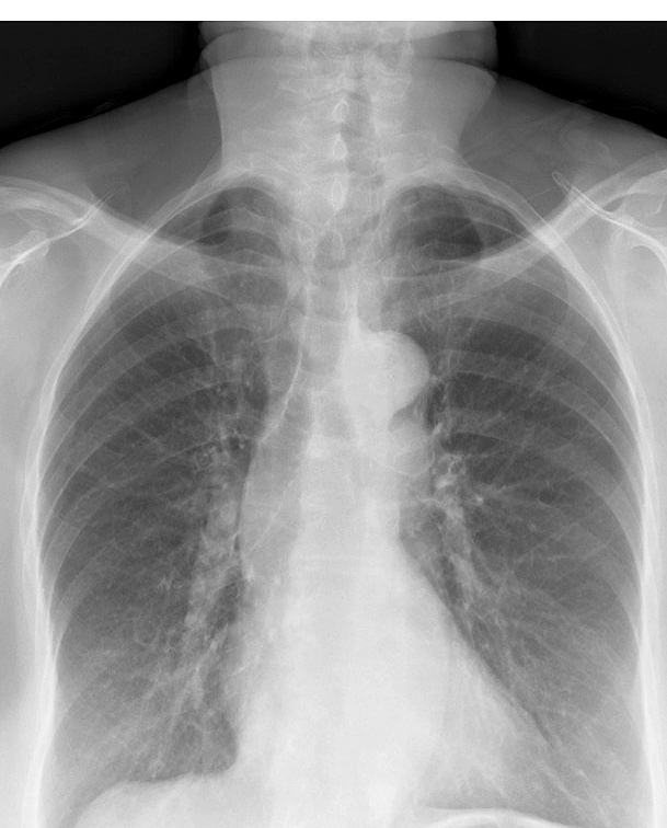 Thyroid Mass
Case 7 PA