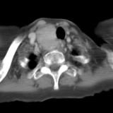 Thyroid Mass
Case 7 CT