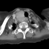 Thyroid Mass
Case 7 CT