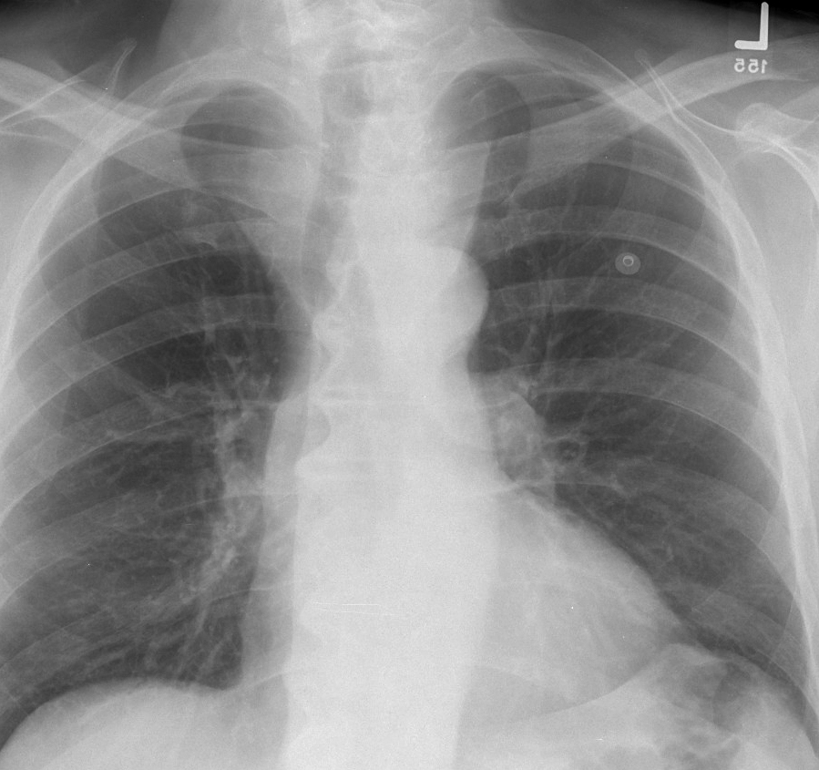 Thyroid Mass
Case 8 PA