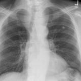 Thyroid Mass
Case 8 PA