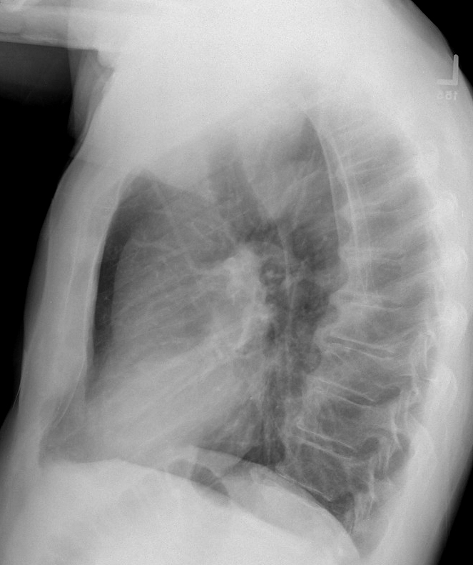 Thyroid Mass
Case 8 Lat