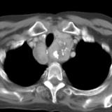 Thyroid Mass
Case 8 CT