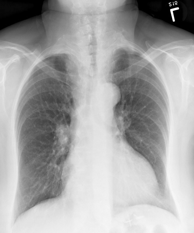 Thyroid Mass
Case 9 PA