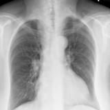 Thyroid Mass
Case 9 PA