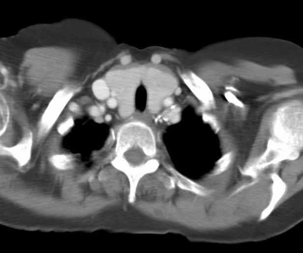 Thyroid Mass
Case 9 CT