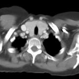 Thyroid Mass
Case 9 CT