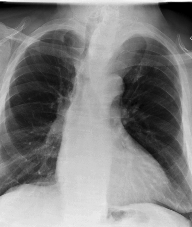 Thyroid Mass
Case 10 PA