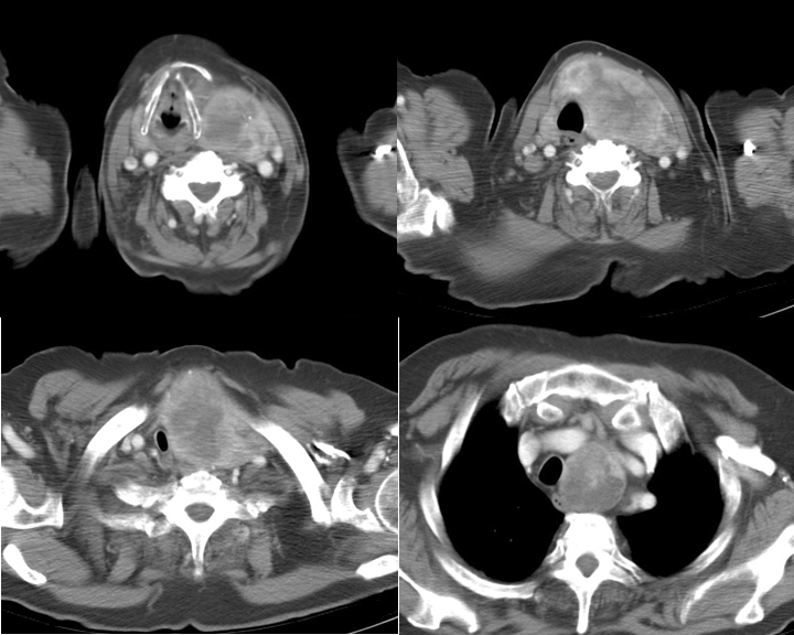 Thyroid Mass
Case 10 CT