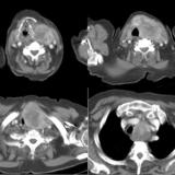 Thyroid Mass
Case 10 CT