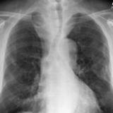 Thyroid Mass
Case 11 PA