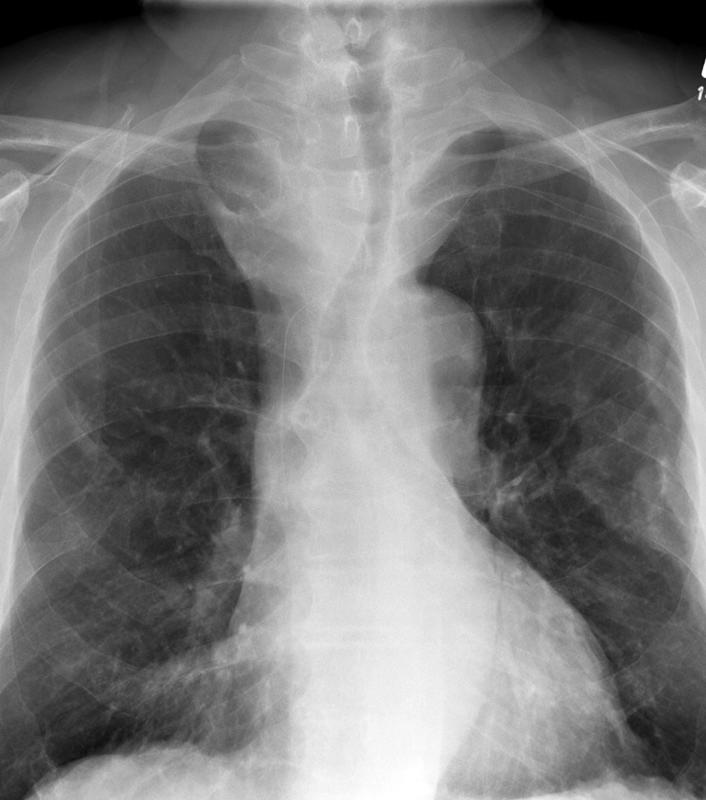 Thyroid Mass
Case 11 PA