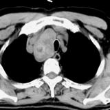Thyroid Mass
Case 11 CT