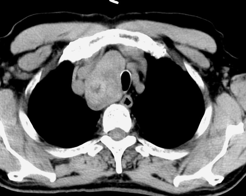 Thyroid Mass
Case 11 CT