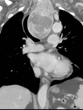 Retrosternal goitre Coronal CT 