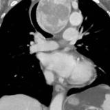 Retrosternal goitre Coronal CT 