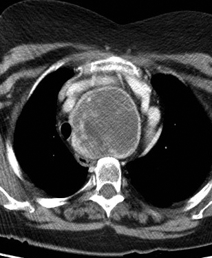 Retrosternal goitre CT axial