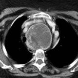 Retrosternal goitre CT axial