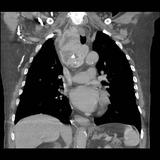 Thyroid mass coronal CT