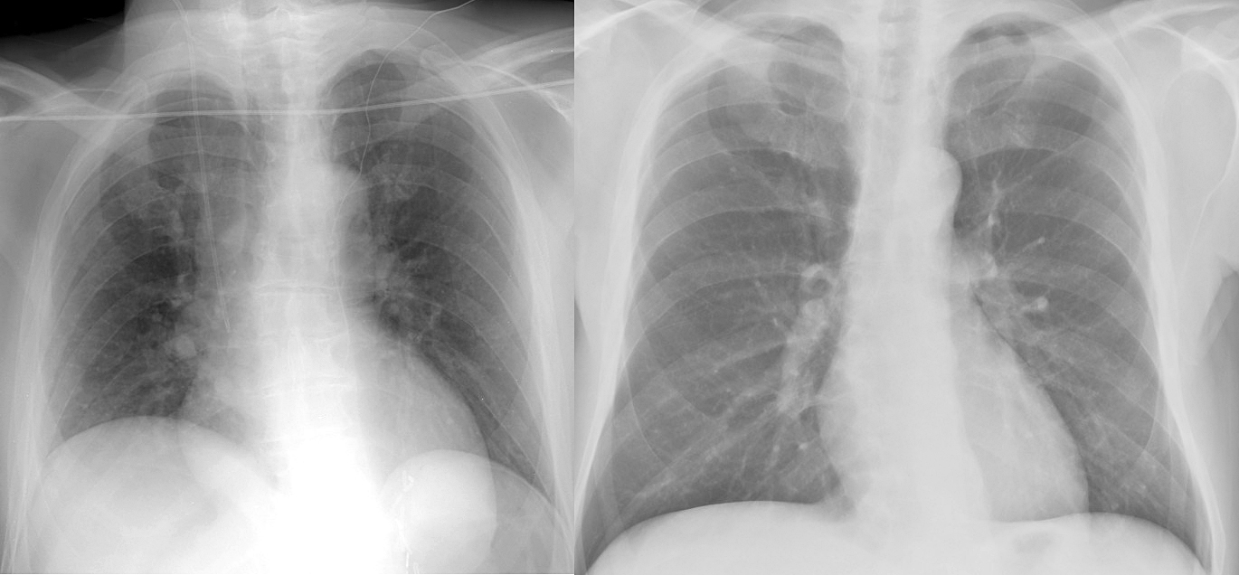 AP sup vs PA upright
Ex 1