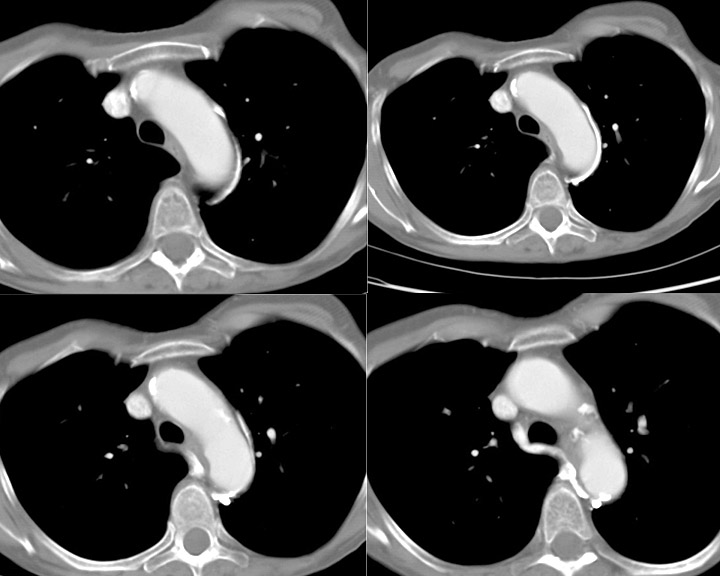 Aortic nipple
Ex 1 CT