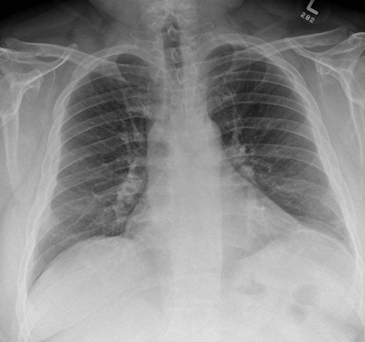 Subpleural fat