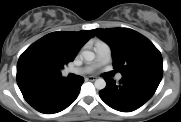 Nl breast CT