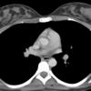 Nl breast CT